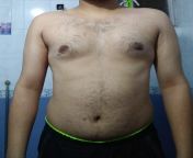 Need help. I had Gynecomastia surgery 1 year ago. Now after surgery i have these hypertrophic scars around my nipple. Moreover i dont think surgery heloed me. I still dont have proper chest. Can someone please tell me how can I improve my physique. from ugly bellies after surgery