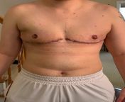 2 weeks post op. Dr. Esther Kim at UCSF from esther alobeli