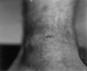 A photograph taken by the Cheshire Constabulary on 7th October 1965 of the minor injury Ian Brady received to his left ankle during the murder of Edward Evans. Ive marked it as NSFW because some people dont like seeing any sort of blood or scabs, but it from the cheshire