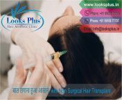 Are you suffering from Baldness??? Not to worry, we are here to your Hair solution... visit our website to contact us www.looksplus.in #looksplus #NonSurgicalHairTransplant from www xx in xxx visit suo sex