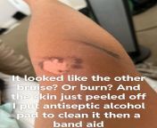 TW: peeled skin from skin