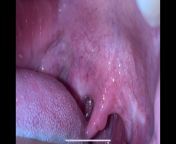 reoccurring sore throat, lump on uvula, hard to swallow, should I go to the hospital? from lump com