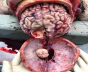 Post-Mortem examination revealing an egg sized meningioma attached to the brain! from desi pehowa post mortem