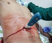 Very deep abdominal stab wound from abdominal