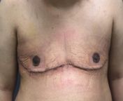 1 Week Post-op DI &amp; nipple grafts w/ Dr Bryan Chung at McLean Clinic! from bryan gozzlig