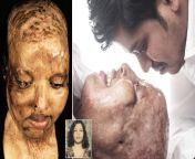 &#39;He loves me for who I am&#39;: Acid attack survivor who was BLINDED when she was doused by a scorned admirer has found love with a man she met while recovering in hospital . India from desi india pregnant delivery video in hospital