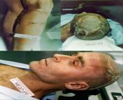 Autopsy photos of serial killer Theodore Robert Bundy, infamously known as Ted Bundy. Shortly after he was executed on January 24, 1989. 12 year old Kimberly Diane Leach was his last victim in February 1978. from nude photos of serial chandanamazha heroine39s amrita