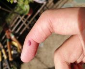 Just separated my dogs from a fight and then I saw this in my finger. from www xxx woman fight and naked