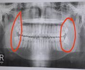 Is it normal na umabot sa 100k yung pagpapabunot ng wisdom tooth? Or hanap na lang ako ng mas murang dental clinic? from gwapings na bagets kilabot ng kaklaan sa tondo