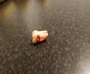 Went to the dentist cause my wisdom tooth was hurting. Turns out it was the tooth next to it. from bunni tooth