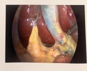 Surgeon gave me a photo of my gallbladder (didnt expect it to be blue?) from vicky gave mtv xxx photo
