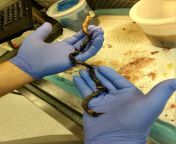 46 cm pulmonary embolus found on post-mortem exam from girl post mortem sexww