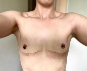 Hey everyone - just wanted to share my results at 3 weeks post op with Dr Rita Yang in Auckland. Super happy with my experience and results so far ? Open to questions or DMs ?? (labelled NSFW ? ) from 13 sal ki ladki or 20 sal ka ladka sex