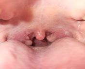I&#39;m aware I have tonsillitis, on antibiotics. Extreme Pain when talking from right tonsil, any advice on soothing it? Also why does my uvula look so chody atm? its never been so swollen before, is it because of the tonsilitis? from extreme pain