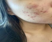 [Acne] Recently start using Palaus choice 2% BHA Liquid Exfoliant for acnes but my skin is getting worse. Is my skin breaking out or purging? from anupama bha