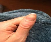 Posting a picture of my thumb. Not very interesting, but Im hoping to pick less by sharing photo evidence. I tear into the skin while Im studying, working, or sitting on the toilet. Sometime until it bleeds - very embarrassing during meetings! from amarpali dubey sex imageavel kiss very sex