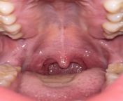I do have an appointment with my ent but of course I have crazy anxiety about this I vape and smoke weed but does my left tonsil look something to worry about Im quitting vaping but I do have tonsil stones pretty regularly! from haia but