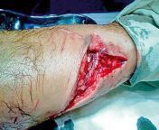Deep leg laceration to leg of French tourist in Sri Lanka; caused by monkey bite. Specifically, it was a Toque Macaque. from mobikama lanka sinhal