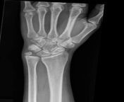 ulnar styloid is this xray normal? f45 from vedika nude xray