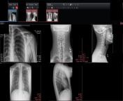 I&#39;ve been having minor pain/soreness in my neck and shoulders for a year and a half. Could anyone tell me if my xray looks okay? Thank you. from neck amp shoulders yoga with jen hilman videos
