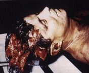 JFKs autopsy from bestgore autopsy