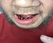??WARNING??Teeth extraction photo from cum teeth