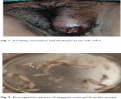 Vulvar myiasis in a 27-year-old woman with mental disabilities from xxnxx old woman