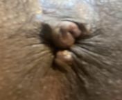 Is this hemorrhoid or skin tag? Got it after first Anal sex and see a new one today from black first anal sex