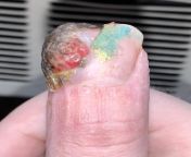 Cut my finger off with a mandolin, Im in the healing stage. Dr says the redness is normal, but its more like a lump, is this really normal? from shared kapoor nudexy cut