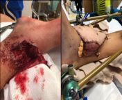 15-year-old Kyle Laman&#39;s right ankle after being shot with a AR-15 during the Parkland shooting. 17 others were killed during the shooting but Kyle managed to flee the school after being shot and give a description of Cruz to police. Doctors later rep from kyle thomas