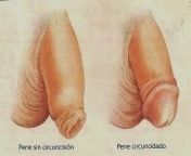 Acucullophilia is a fetish for people who are turned on by the idea or act of someone being circumcised willingly or by force. Sometimes, Acucullophiliacs are just turned on by the appearance of a circumcised penis. from circumcised vigina