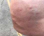 Just got stung by one of those little black and yellow fuckers for the first time in my life (36). Inside right forearm. Was walking by a river for a nice relaxing evening stroll, and stopped to sit on a bench. I failed to see the nest behind the bench. I from film the tin drum film