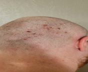 My partner gets these sores on the back of his head. We decided to shave his head so we could more effectively apply lotion and it&#39;s much worse than we thought. Any ideas? from မြနမာဖူးကားpizzaboy 15indianopengirlcodrixxx imgaes rambvideo moavan andhra woman head shave templehi xxx tasxce 2060 comamil naika kajol xx