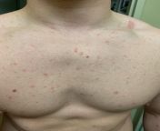 Woke up about a 4 days ago with these red dots all over my chest and back and couple on my stomach.Seems like I keep getting more but I cant tell. There not on my arms legs or anywhere elses just back and chest and they dont itch. Anyone got an idea ? from all anal zoe bloom and rosalyn sphinx in an anal threesome jpg