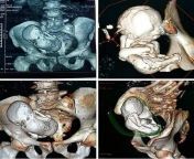 Doctors found a calcified fetus of 30 years old in the uterus of a woman aged 73 years old. These 3D CT scans belong to an Algerian women with a fetus that was inside her for over 30 years. from nude of old woman