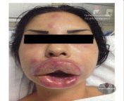 If you want cosmetic work done this bad, just go to a doctor. Story: 7 days before arriving at the hospital, she injected the contents of fish oil capsules into her lips and eyebrows for a cosmetic effect. from cosmetic raw materials drug ingredients contact：biokvbett99@hotmail com mgf