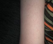 Rash on my arm whats the cause I do have arm hair ask questions in comments from unsave under arm hair girl odisa