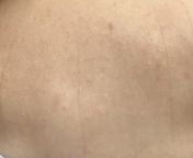 HELP! Bumps on 4 month olds chest and in diaper from newborn 124 2 4 month old baby