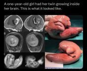 A girl had her twin growing inside her brain. The image on the right is the x-ray, the right is after the procedure of removal of the parasitic twin from chitra shukla fake nude x ray image