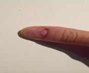 I am biting my nails extremely. Not exactly biting but I am tearing off my nail with my other hands nail. I am doing it since I was 12 without any psychological reason (I guess) and I couldn&#39;t stop it. It hurts and I don&#39;t enjoy doing it. from biting
