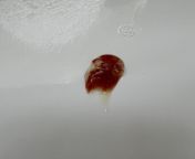 25m, cough and cold for two weeks has eased, every time I blow my nose sticky mucus blood comes out. from indian virgin first time sex blood comes out