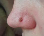 Irritation bump on nostril piercing from nostril