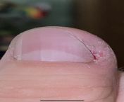Can I remove my own nail bed scar? I cut the callus skin and new nail. There is overgrowth and it is uncomfortable everything. from callus