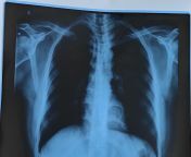 Can anyone see lungs xray from sneha xray phota