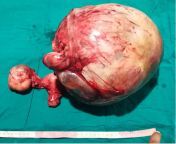 An exorbitant 12-kilogram mass removed from a 48-year-old womans abdomen. They did a lower midline laparotomy and a total abdominal hysterectomy with bilateral salpingo-oophorectomy. from xxnxx old woman