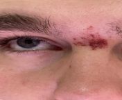Damaged my skin waxing eyebrows from bengali skin