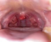 Uvula in severe pain after endoscopy, hard to swallow... not sure if this is normal or to go to the doctor lol from spank severe