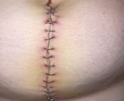 Is my surgical incision infected? Please help. Surgery was 09/26 from 谷歌推广代发【电报e10838】google推广优化 ulg 0926