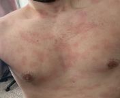Boyfriend gets this rash on face and body every time he gots hot, thinking it was heat rash but it looks nothing like pics of heat rash on google. does anyone know what this could be? lasts anywhere from a few min to a half hour. from 阿富汗♛㍧☑【免费版jusege9 com】☦️㋇☓•rash