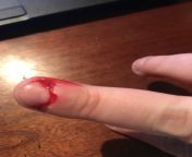 NSFW- Does anyone else bite and pick their cuticles? Just did this while on a phone call looked down and blood everywhere. How embarrassing from fast time xxx and blood fergnet
